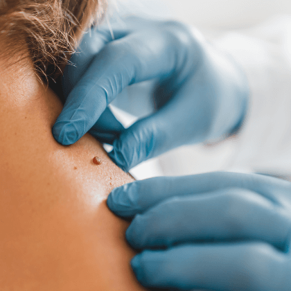 Dermatología: ¿está incluida en el seguro de salud?